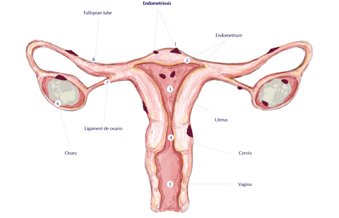 Endometriosis Doctor Dubai