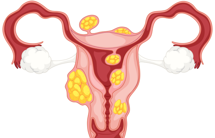 Fibroids Treatment in Dubai