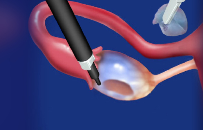Ovarian Cystectomy