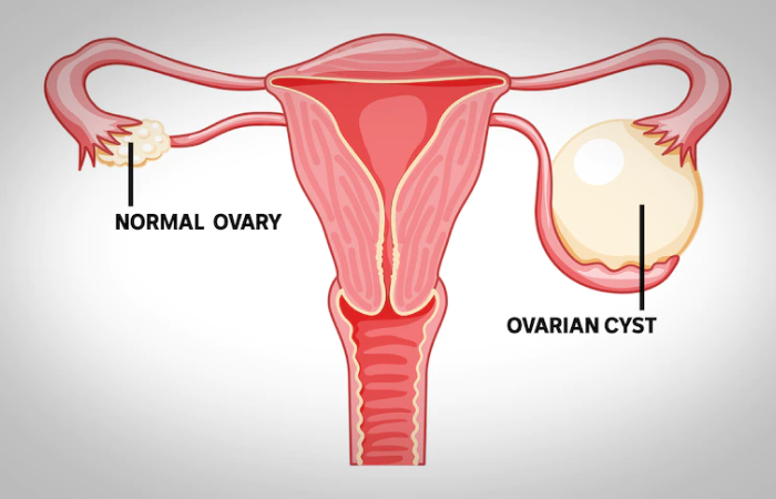 Ovarian Cyst Removal Dubai