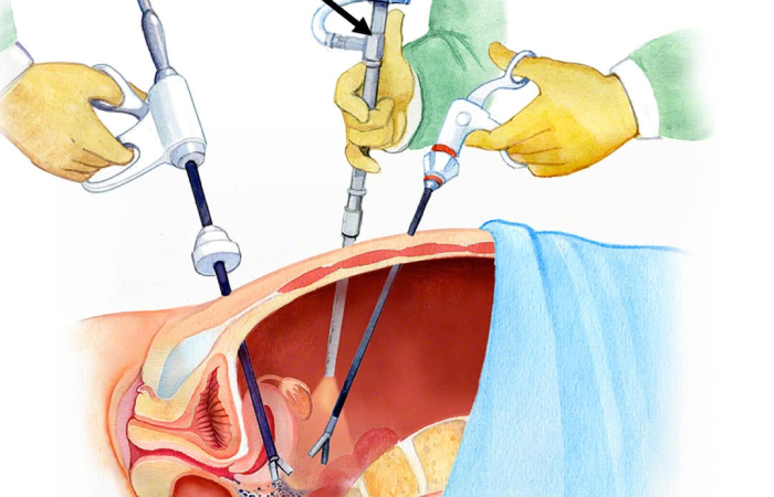 Endometriosis Surgery in Dubai