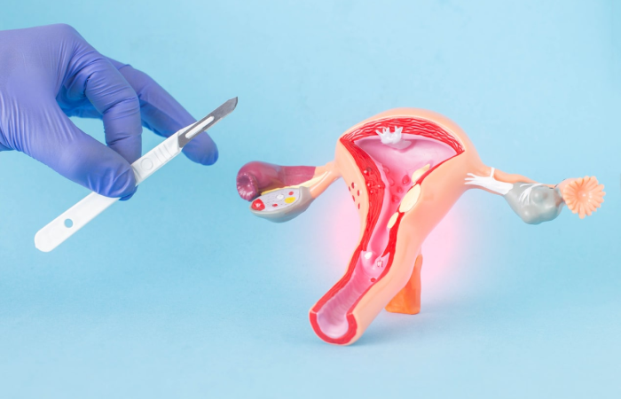 Endometriosis Surgery in Dubai