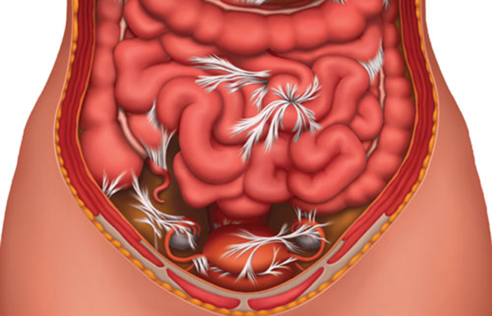 Adhesions