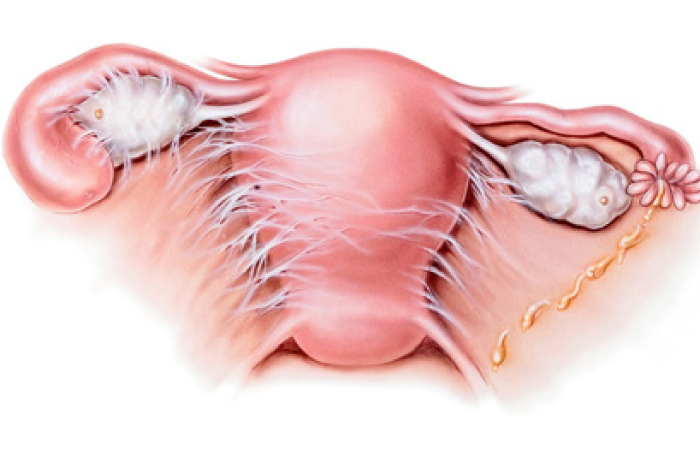 Laparoscopic Adhesiolysis in Dubai
