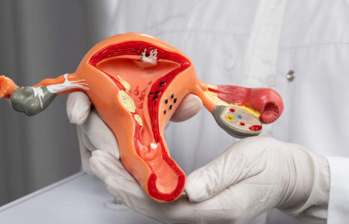 Hysteroscopic Myomectomy in Dubai