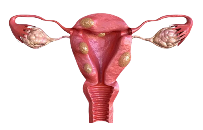 Hysteroscopic Myomectomy in Dubai
