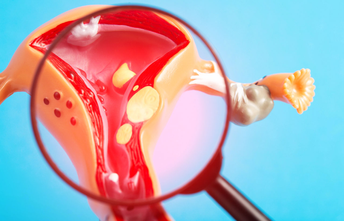 Fibroids Treatment in Dubai