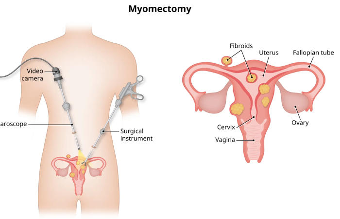 Laparopscopic Myomectomy in Dubai