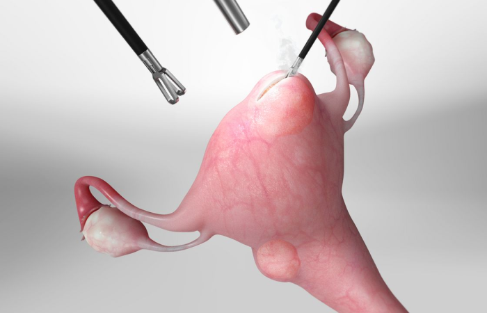 Laparopscopic Myomectomy in Dubai