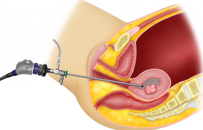 Hysteroscopic Treatment for Adhesions in Dubai