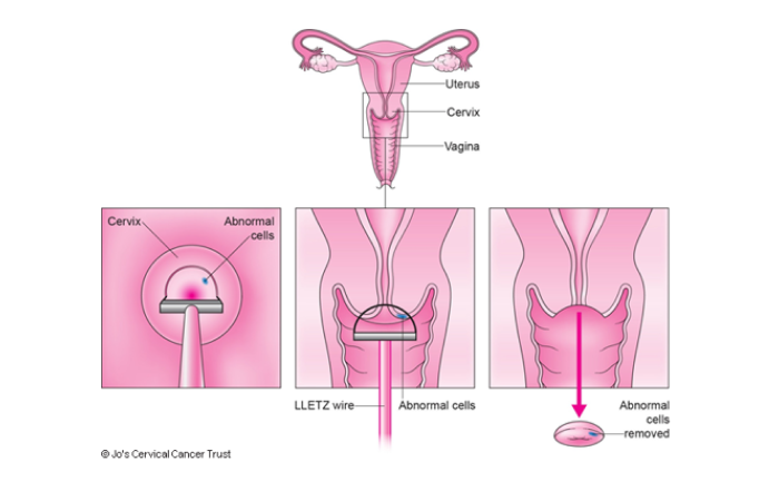 LLETZ Biopsy in Dubai