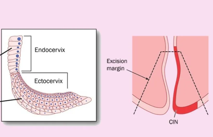 LLETZ Biopsy in Dubai