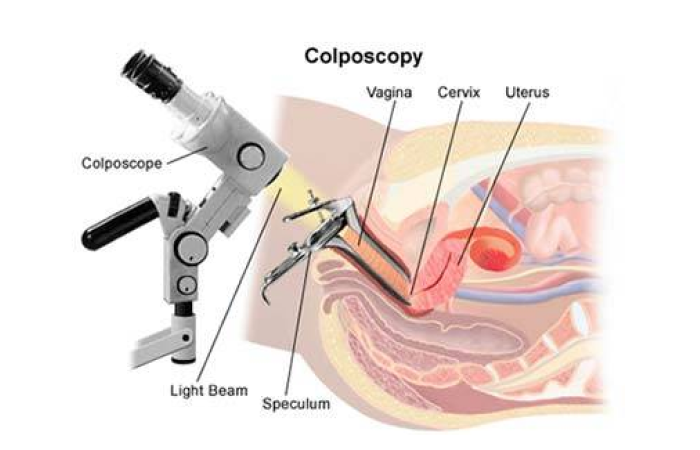 Cervical Biopsy in Dubai