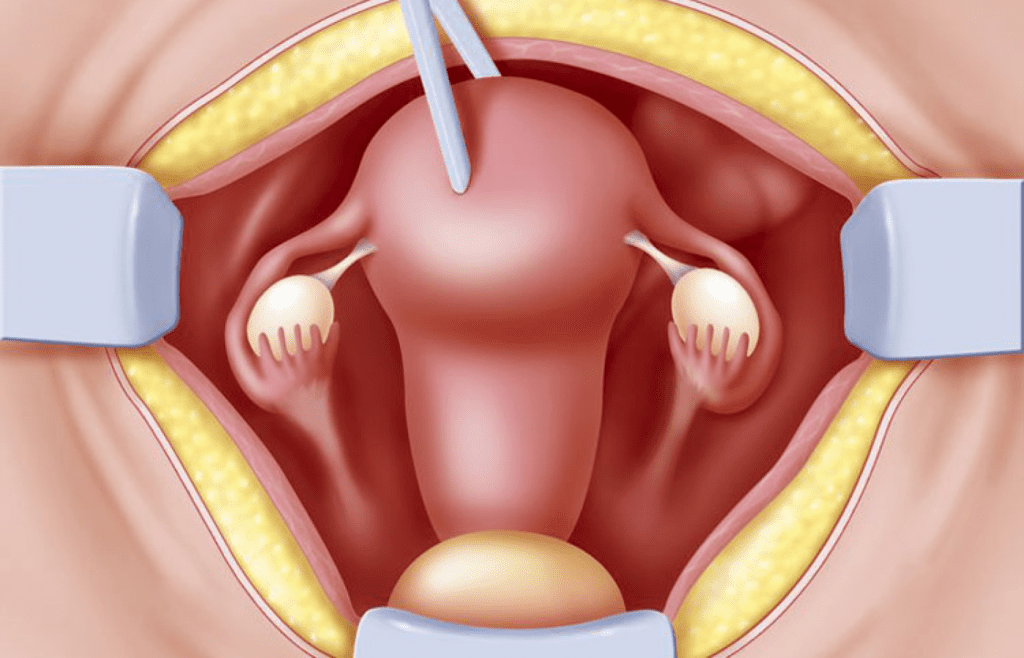Laparoscopic Hysterectomy in Dubai