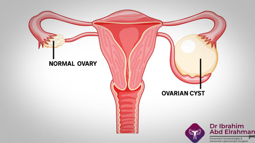 What Size of Ovarian Cyst Is Dangerous in MM