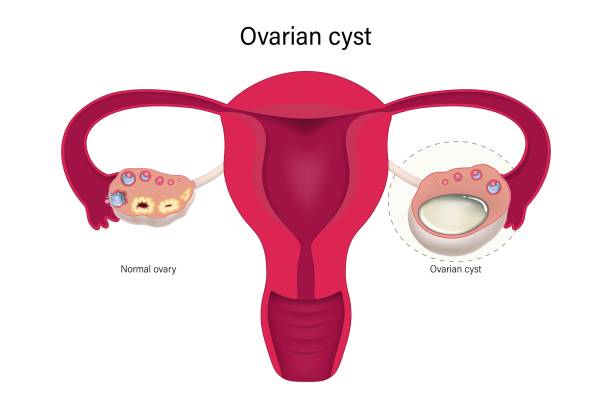 What Size Of Ovarian Cyst is Dangerous